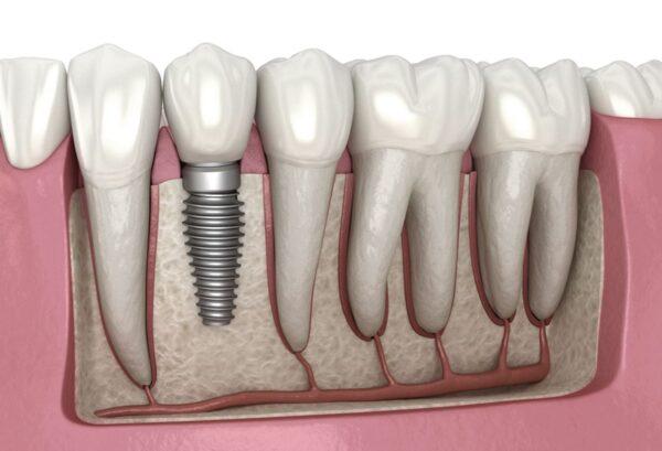 Dental-Implants-101_4-600x409.jpeg