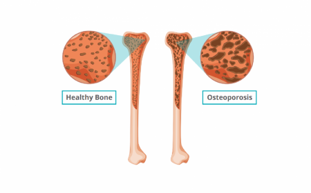 osteoporosis2.png